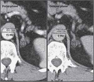 Adrenal adenoma. A 56-year-old patient investigated for a left renal mass. Intravenous contrast-enhanced abdominal CT scans, portal phase at 60s and delayed phase at 15min, show a nodular lesion in the left adrenal gland. No unenhanced scan is available and, therefore, the absolute washout cannot be estimated. Nonetheless, the relative washout of 96% is suggestive of adenoma.