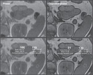 Adrenal adenoma. Abdominal MRI in a 52-year-old patient investigated for an incidentally discovered adrenal nodule on CT in the left adrenal gland. Opposed-phase gradient echo sequence shows a significant signal loss of the nodule in comparison with the in-phase sequence, which is highly suggestive of adrenal adenoma.