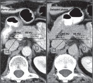 Adrenal metastasis. IV contrast-enhanced CT scan, portal phase at 60s and delayed phase at 15min, in a patient with a history of breast cancer shows round/oval homogeneous nodules with smooth, well-defined margins in both adrenal glands. The lesions show unspecific relative washout of 28% (right) and 12% (left). CT follow-up at 4 months demonstrated enlargement of the lesions, which confirmed the diagnosis of metastasis.