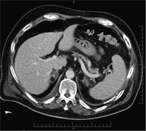 Myelolipoma. IV contrast-enhanced portal-phase abdominal CT examination in a 61-year-old-patient investigated for evaluation of complications after radical prostatectomy. The scan shows bilateral lesions with a predominance of fat density, compatible with myelolipomas.