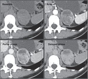 Pheochromocytoma. Multiphasic abdominal CT scan shows a heterogeneous solid lesion in the left adrenal gland with smooth and well-defined margins that enhances intensely during the portal phase, suggestive of pheochromocytoma.