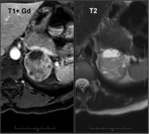 Pheochromocytoma (same patient as Fig. 8). MRI with intravenous contrast material shows a heterogeneous mass with hypersignal areas on T2-weighted images, and heterogeneous areas of hyperintensity on arterial-phase T1-weighted images, suggestive of pheochromocytoma.