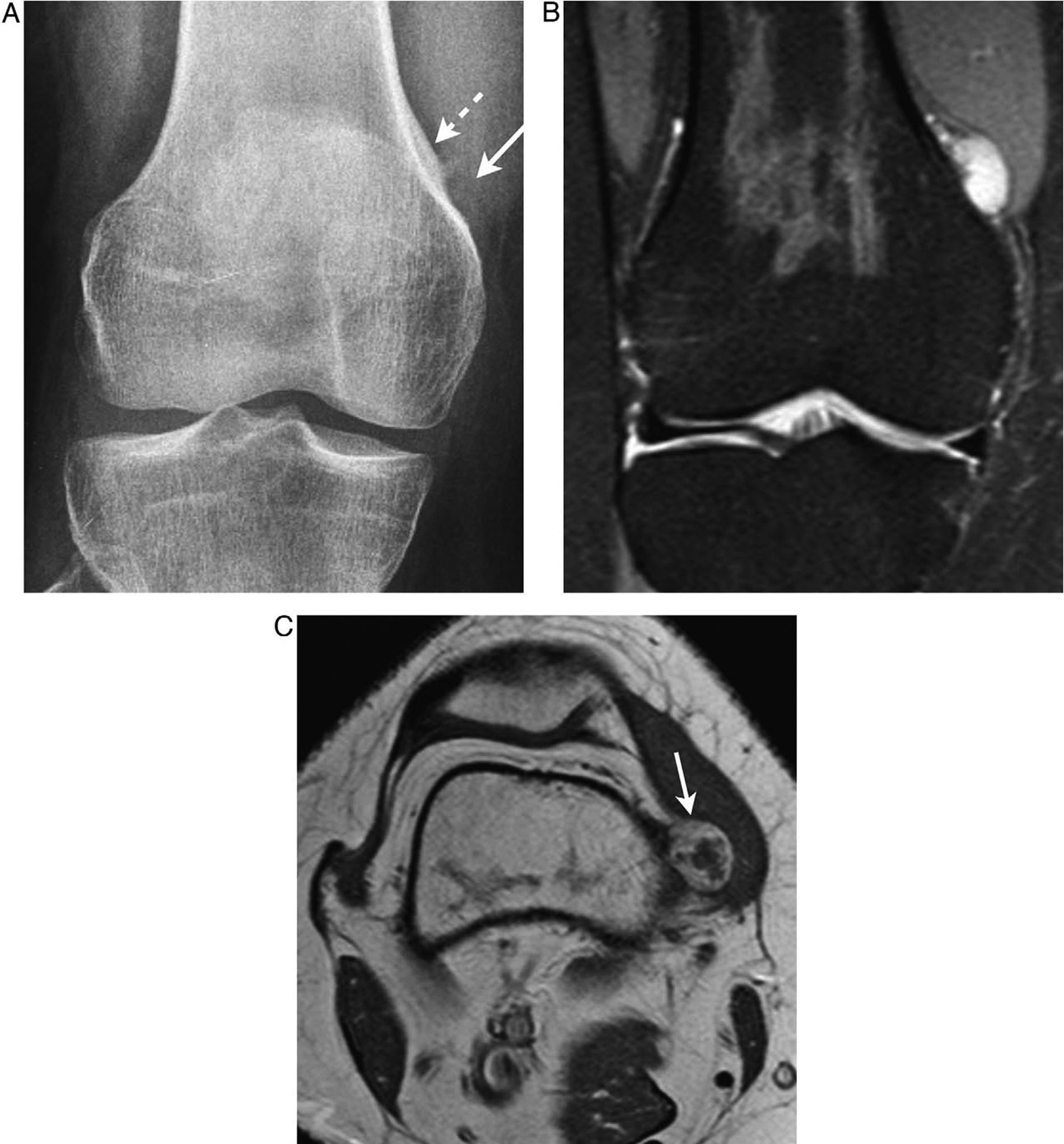 Partial Peripheral Rim Defect Articular and periarticular tumors: Differential diagnosis using ...