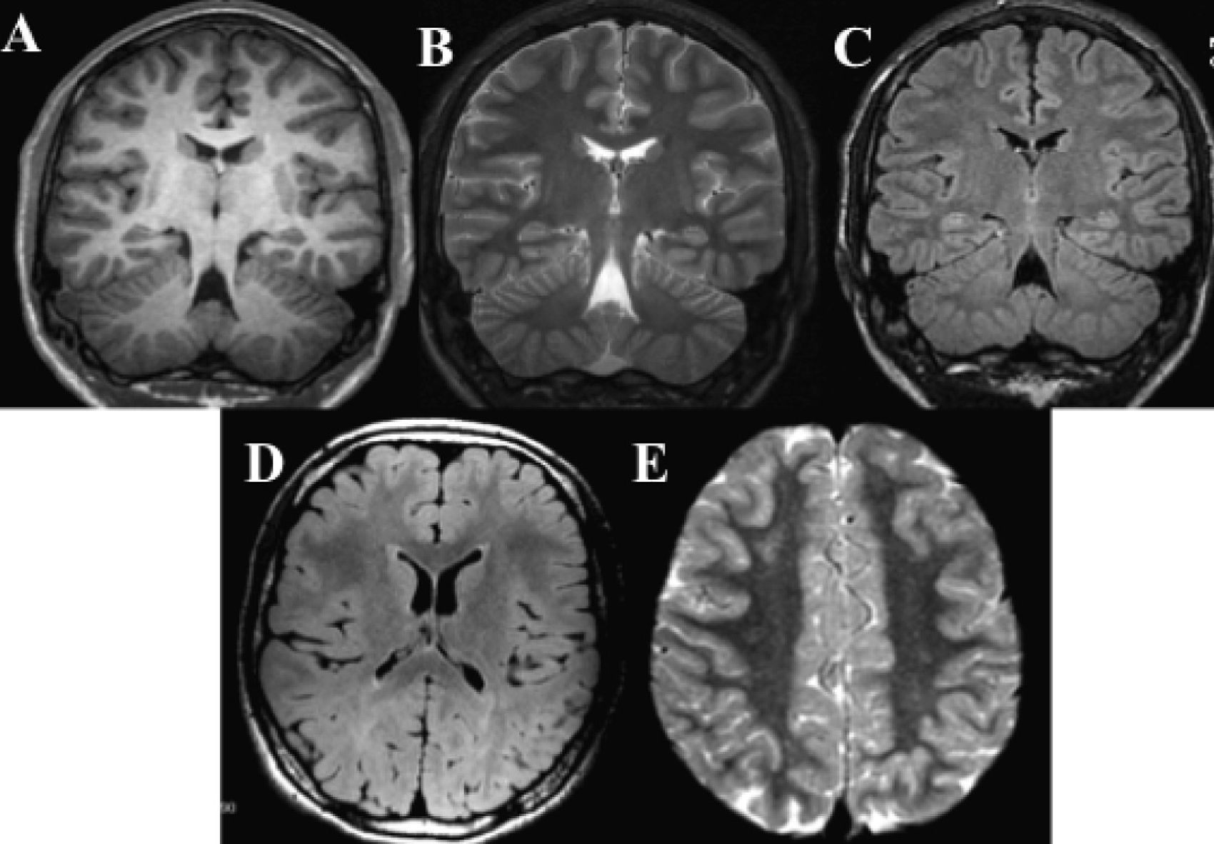 Structural magnetic resonance imaging in epilepsy | Radiología (English ...