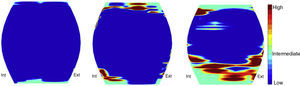 Nosologic map that describes the different degrees of articular cartilage degeneration. On the left, the image shows the coronal view of a normal patellar cartilage. The color scale shows the degree of degeneration. The central and right images depict patellar cartilages with early and advanced degeneration, respectively. These nosologic maps derive from discriminant functions, in which the value of the functions represents the probability of a given pixel being pathological.