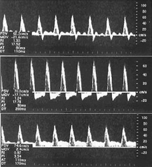 Diastolic retrograde arterial flow: Preliminary report | Radiología ...
