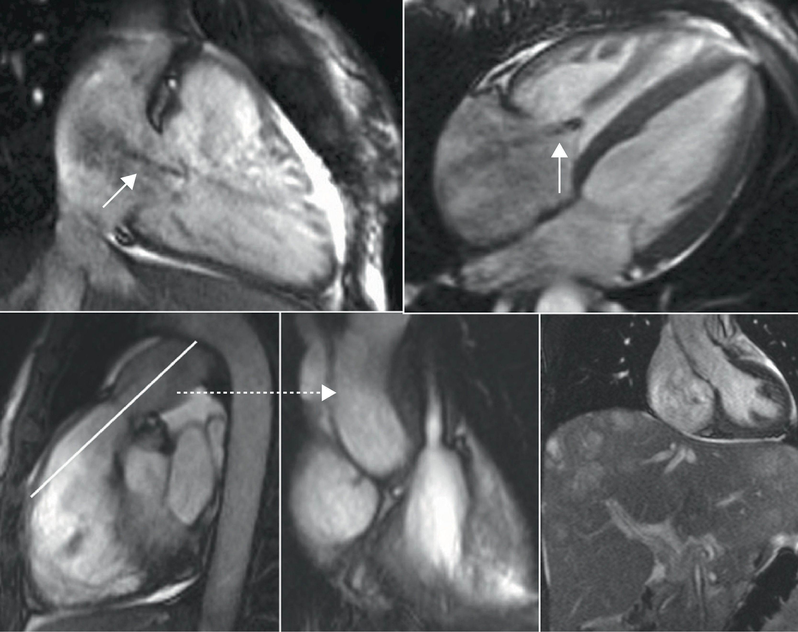 Study of the right ventricle using magnetic resonance imaging ...