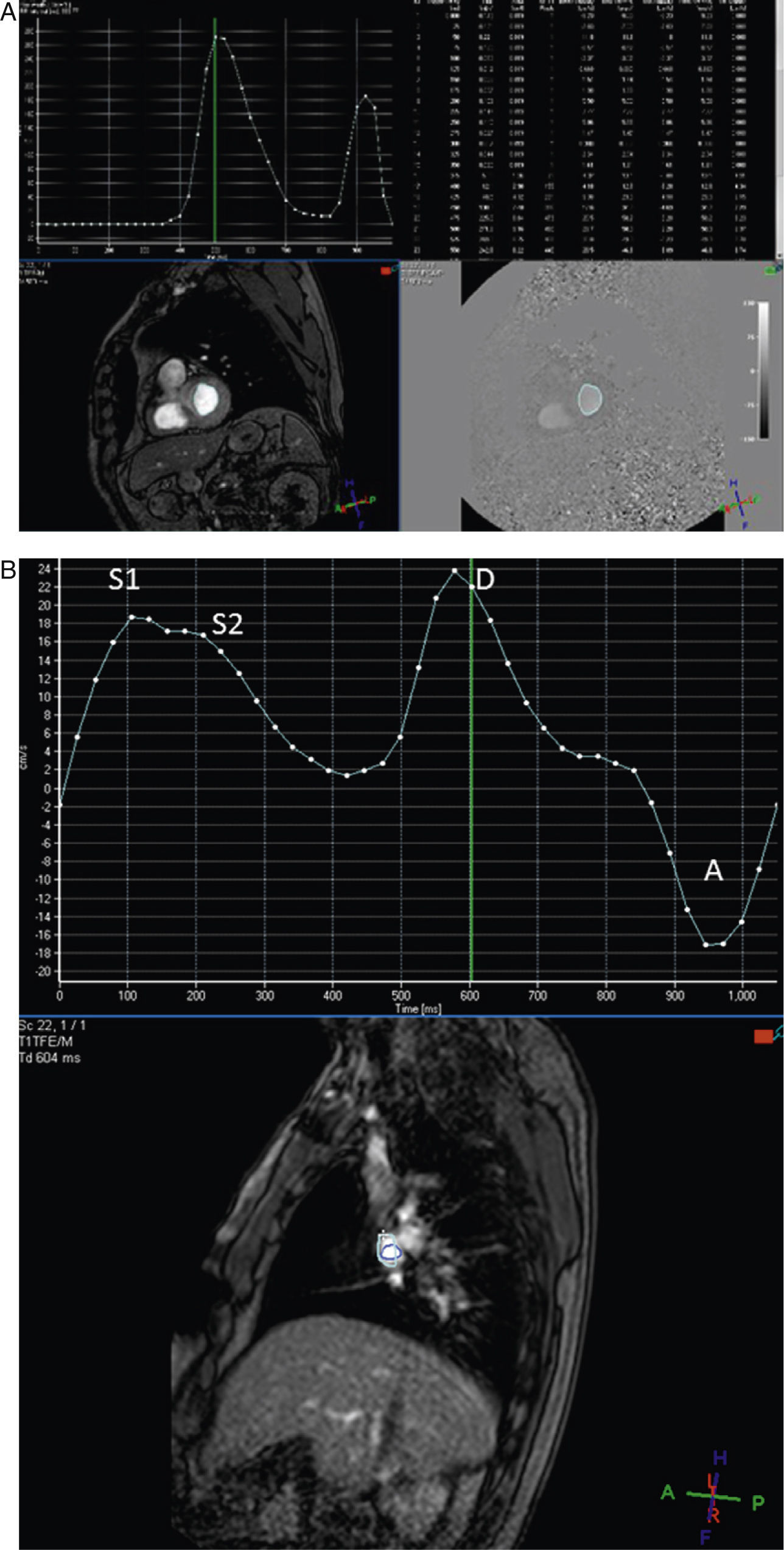 Analysis of left ventricular diastolic function using magnetic ...