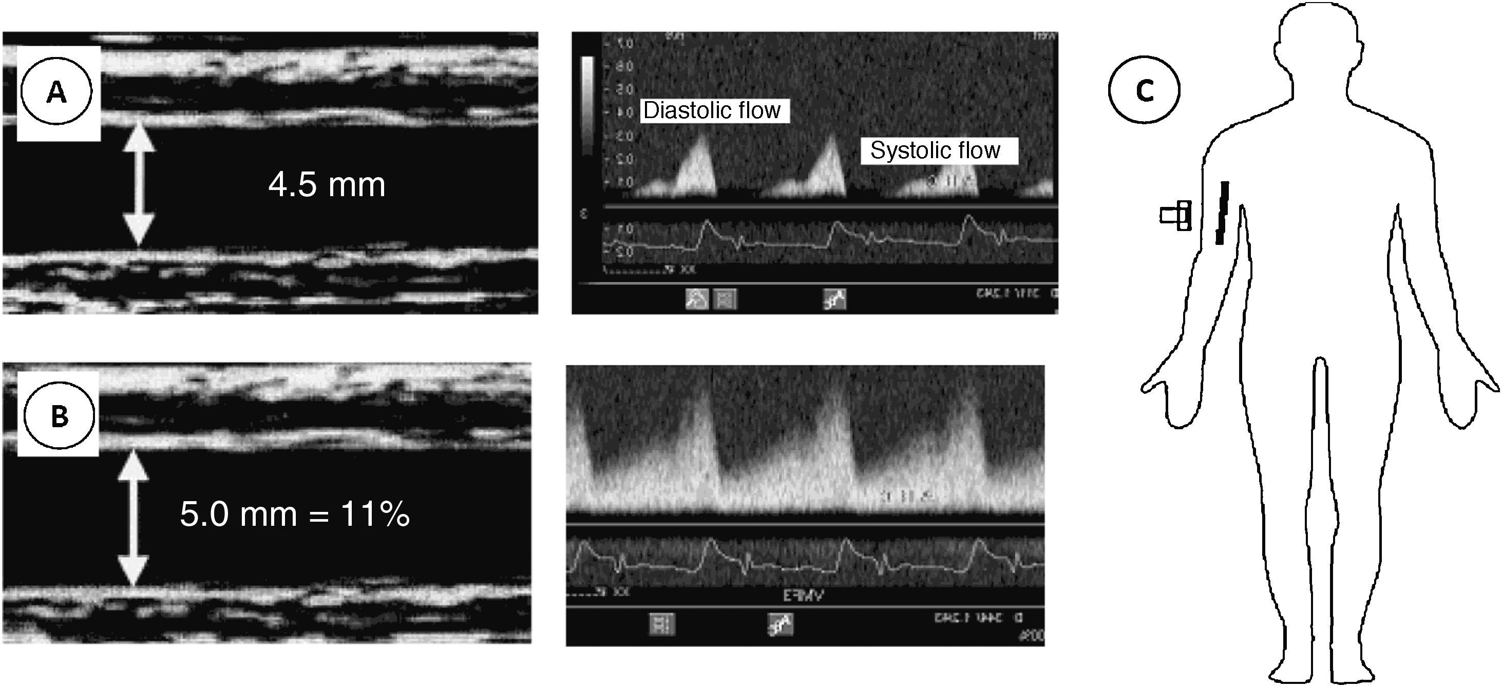 Effects of two methods of heat therapy on the acute vascular response ...