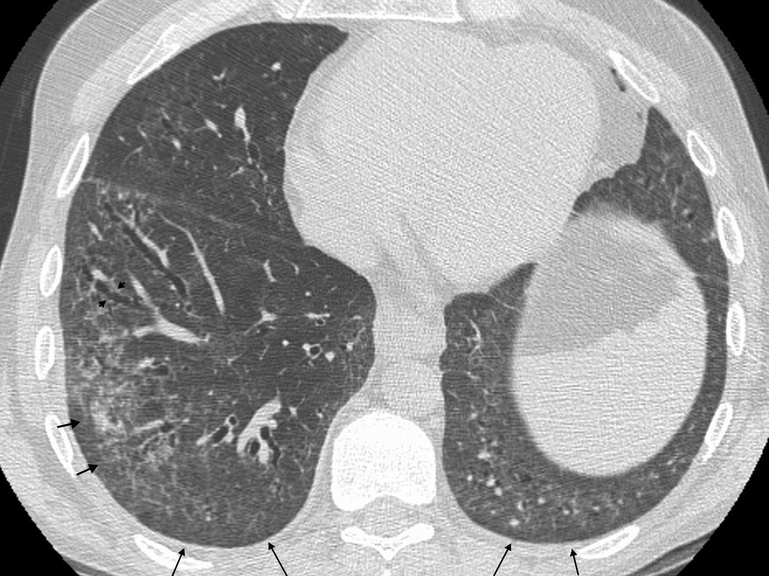 Pneumosclerosis Lung disease associated with connective tissue disease | Radiología ...