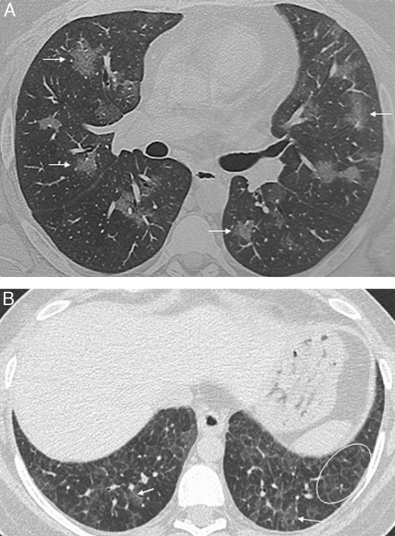 Typical Reticulation Line Lung disease associated with connective tissue disease | Radiología ...