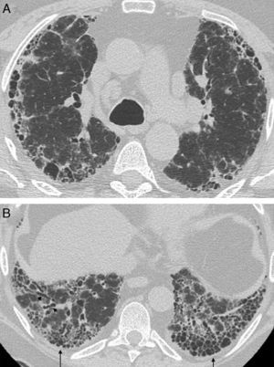 Lung disease associated with connective tissue disease | Radiología ...