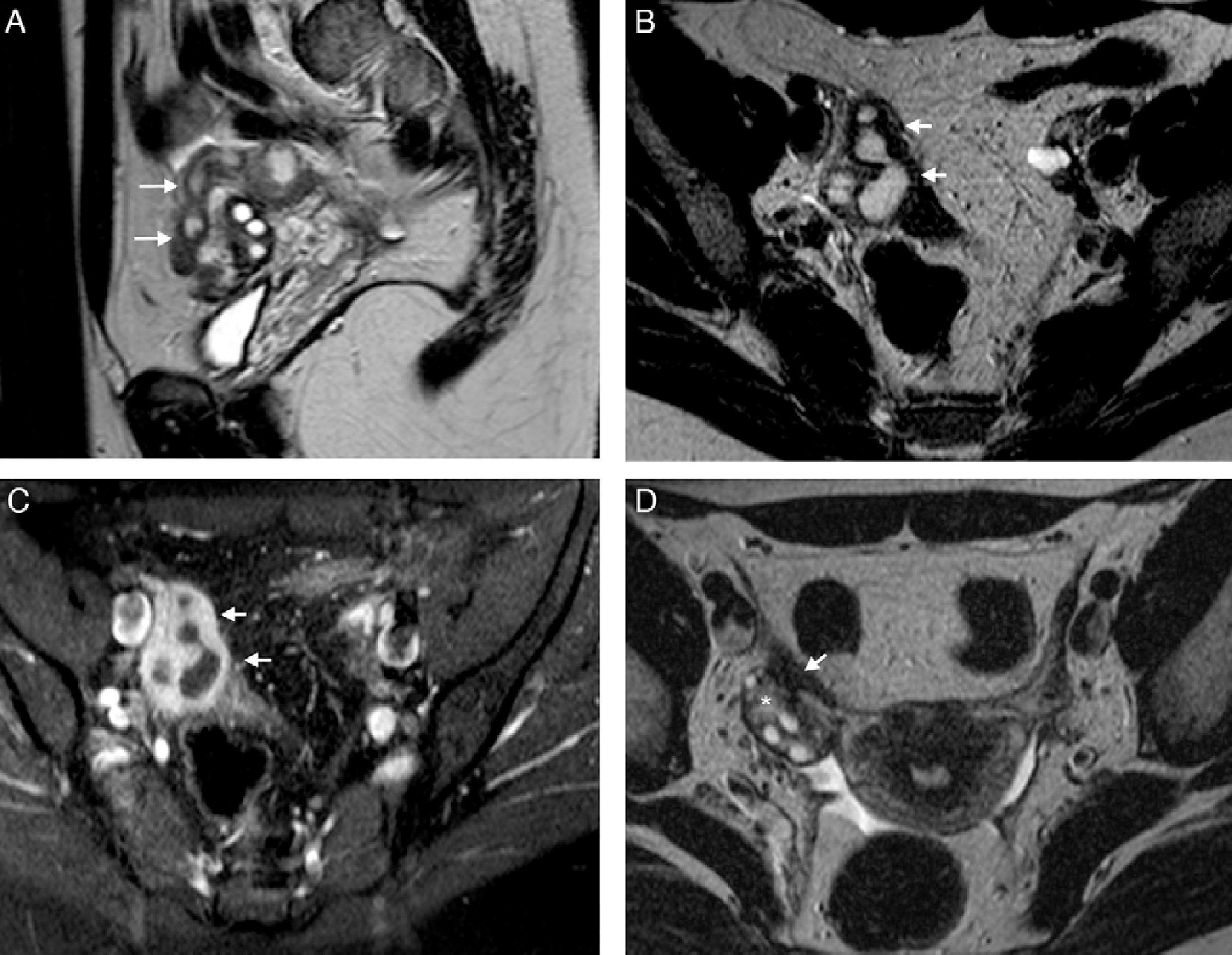 Pyosalphix Mri Fallopian tube disease on magnetic resonance imaging | Radiología ...