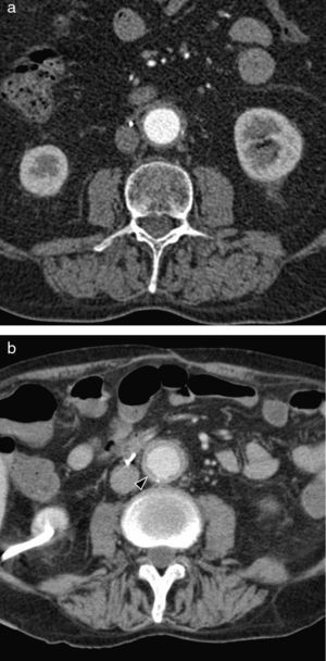 Drug-induced aortitis in a 78-year-old man with vesical neoplasia in gemcytabin treatment. Axial CT image of before (a) and after (b) beginning of treatment, showing mural aortic thickening with contrast uptake (arrow head).