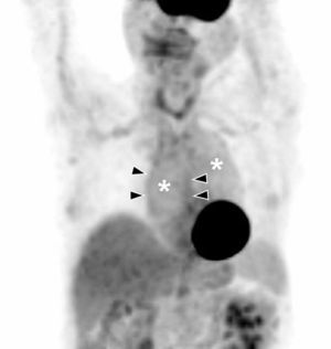 Aortitis: Thoracic PET coronal image. Diffuse hyperactivity in ascending and descending aorta (asterisks) with more focal images delimiting aortic wall in the ascending segment (arrow heads). Image by courtesy of Doctor Albert Flotats Giralt. Nuclear Medicine Service. Hospital de la Santa Creu i Sant Pau in Barcelona.