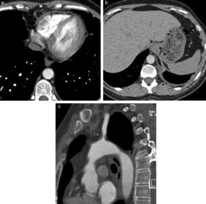 Systemic lupus erythematosus in a 36-year-old woman. Axial CT images with contrast showing affectation of serosas: (a) pericardial thickening (arrow heads) and (b) effusion and left pleural thickening (arrow heads). (c) CT Sagittal MPR reconstruction with contrast showing mural thickening and left subclavian artery stenosis (arrow head).