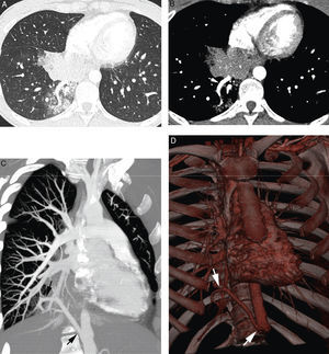 26-year-old patient without known antecedents presenting life-threatening hemoptysis. (A) CT with lung window showing a consolidation in the lower right lobe, with frosted-glass images around it. (B–D) angio-MDCT images. Axial cut (B) showing an anomalous vascular image (arrow) in the right lower lobe adjacent to the consolidation. The oblique coronal MIP reconstruction (C) shows an anomalous vessel originating in the abdominal aorta (arrows) and going into the right lower lobe, confirming that the parenchymatous affectation is a pulmonary sequestration. Volume reconstruction (D) showing the anomalous vessel (arrows). The reconstructions allow us to observe the angle of the anomalous vessel as it exits the aorta.