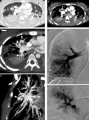 Patient with septic embolisms and life-threatening hemoptysis. (A) CT with lung window in which it is possible to observe multiple bilateral cavitated lesions, some with thin walls, others with thick walls, which correspond with septic embolisms (arrows). (B–E) Angio-MDCT images. It is possible to observe (B) multiple dilatations of the pulmonary arteries (arrows), some of them adjacent to a cavity (white arrow), which corresponds to multiple mycotic pseudoaneurysms. Axial MIP reconstruction (C) showing 2 aneurysms in anterior segmentary branches of the right upper lobe (arrow heads) and another aneurysm in a right lower lobe segmentary branch (arrow). Sagittal MIP reconstruction (D) showing the 3 right aneurysms, 2 in the right upper lobe (arrow heads) and one in the right lower lobe (arrow); global pulmonary arteriography (E) in which the pseudoaneurysms cannot be seen. (F) Supraselective arteriography where one of the right upper lobe aneurysms can be observed.