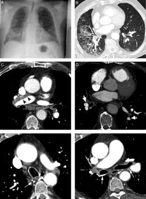 Patient with chronic pulmonary thromboembolism who comes due to life-threatening hemoptysis. (A) Thorax radiography with consolidations in the right pulmonary base corresponding to the area of bleeding. (B) The CT with lung window shows frosted-glass areas in the middle lobe and the right lower lobe. (C–H) Angio-MDCT images. Axial cuts (C and D) showing signs of chronic pulmonary thromboembolism with a large peripheral thrombus in the main right pulmonary artery (arrow heads), as well as linear images inside the lobar and segmentary branches and in the right lower lobe and the left lower lobe respectively, corresponding to residual bands (arrow). Linear and punctiform images (E and F) in the mediastinum, with contrast similar to that of the aorta (arrows), which correspond to hypertrophied bronchial arteries. The coronal MIP reconstruction (G) shows a right intercostobronchial trunk (white arrows) and a hypertrophied common bibronchial trunk (black arrows). The findings were confirmed in the arteriography, which showed the right intercostobronchial trunk's hypertrophy (H: arrows, thin arrows in the intercostal branch) and the bibronchial trunk hypertrophy (I: arrows). Observe the analogy of the arteriography and the angio-MDCT images.