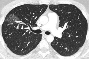 Patient who comes due to right pleuritic pain and life-threatening hemoptysis. CT with lung window showing signs of bleeding in the right upper lobe in the form of frosted glass and centrilobular nodules, with occupation of a subsegmentary bronchus (arrow heads) which runs parallel to the pulmonary artery.