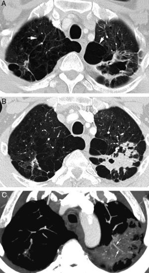 Patient in treatment for atypical mycobacterial infection presenting life-threatening hemoptysis. (A) CT (lung window) performed 5 months before the hemoptysis episode showing an irregular-wall cavitated lesion in the upper left lobe. In addition, it is possible to observe an important affectation by centrilobular and paraseptal emphysema (arrows). (B) CT (lung window) where it is possible to observe cavity occupation by the bleeding. (C) Axial MIP reconstruction, showing branches of the pulmonary arteries (arrows) in the lower peripheral portion of the cavity. Moreover, many small focal images are observed that correspond with calcified granulomas.