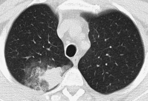 Patient with life-threatening hemoptysis. CT with lung window, where it is possible to observe a consolidation in the posterior segment of the right upper lobe, secondary to the bleeding, with an adjacent opaque glass area, findings resolved completely in the control CT performed a month later (not shown).