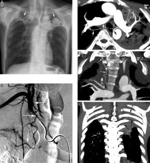 Patient with bilateral aspergillomas and life threatening hemoptysis. (A) Thorax radiography showing important volume loss of the upper lobes with large cavities in both. Nodular images are observed within the cavities (arrows) corresponding to the aspergillomas. (B) Axial MIP reconstruction where we observe hypertrophy of the right (white arrows) and left (black arrows) bronchial arteries, as well as the mycetoma (*). (C) Coronal MIP reconstruction showing an ectopic bronchial artery originating in right subclavian artery and going into the lung along the hilius (arrows). (D) Arteriography showing the ectopic bronchial artery originated from the right subclavian (arrows). (E) Posterior coronal MIP reconstruction showing in addition hypertrophy of the first left intercostal arteries (arrows) adjacent to the pleural thickening accompanying the left upper lobe aspergilloma.