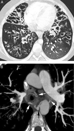 Patient with cystic fibrosis and life-threatening hemoptysis. (A) CT with lung window in which it is possible to observe extensive bilateral affectation by bronchiectasis (predominant in the middle lobe and the lingula), mucous impacts and air trapping areas in both lower lobes. (B) Axial MIP reconstruction showing multiple pathological bronchial arteries (white arrows). The right intercostobronchial trunk presents aneurysm (black arrow). Multiple mediastinal adenopathies reactive to repetition infections may be observed (*).