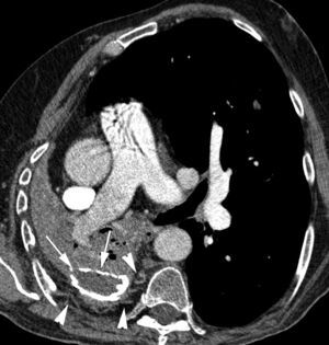 Patient with tuberculous sequels and necrotizing pneumonia affecting the right lower lobe. CT with contrast showing an important volume loss of the right hemithorax, with calcified chronic pleural collection on the right hemithorax base (arrows). An increase of subpleural fat is observed, along which the hypertrophic, tortuous intercostal artery runs (arrow heads).