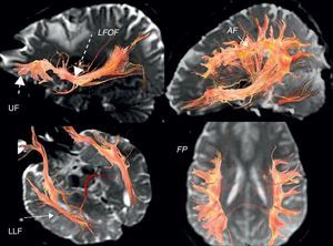 3D tractography. Functional subcortical fasciculi implicated in language. AF: arcuate fasciculus (short continuous arrow); LFOF: lower frontooccipital fasciculus (long discontinuous arrow); LLF: lower longitudinal fasciculus (long continuous arrow); FP: frontoparietal bundle; UF: uncinate fasciculus (short discontinuous arrow).