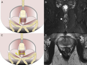 Intersphincterian fistulas. (A and C) Coronal-plane schemes of simple and complex intersphincterian fistulas, respectively. (B) T2-weighted coronal image with fat suppression showing one type 1 intersphincterian fistula (hollow arrows) keeping the external sphincter plane untouched (solid arrow). (D) T2-weighted axial image showing one type 2 horseshoe-like fistulous trajectory (hollow arrows) confined by the untouched external sphincter (solid arrow).
