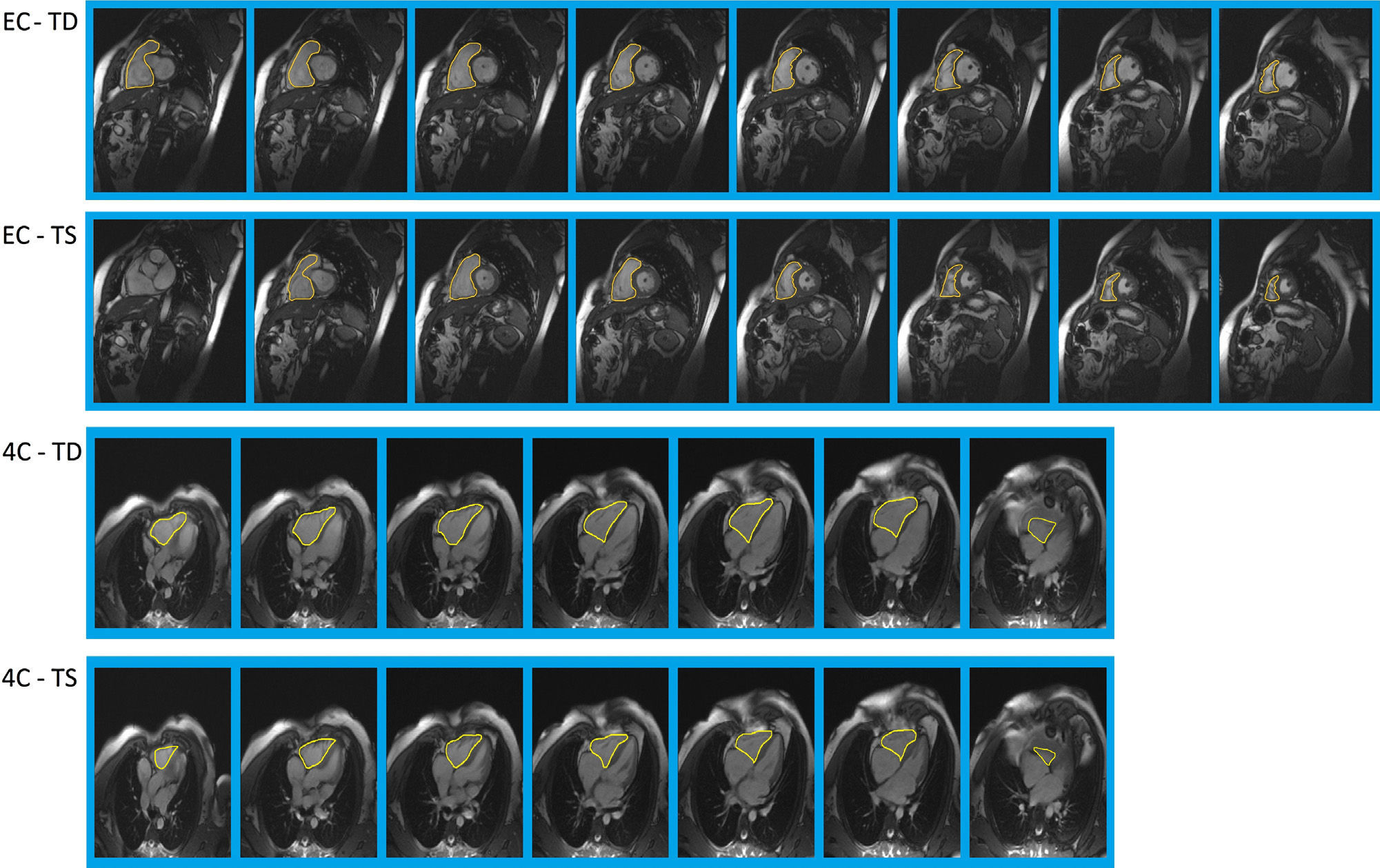 Cardiac magnetic resonance analysis of right ventricular function ...