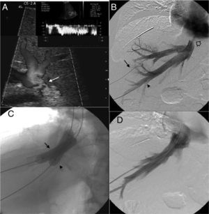 Patient with orthotopic hepatic transplant with the piggyback technique showing ascites and alteration in the liver function tests. (A) Ultrasound. Color Doppler images showing stenosis of the piggyback anastomosis (arrow). The wave shape of the hepatic vein in the pulsed Doppler study shows flattening with no breathing alterations. (B) Venographic study. Selective catheterism of the right and middle hepatic veins through transhepatic access with ultrasound control (arrow and arrowhead). The contrast agent confirms stenosis of the piggyback anastomosis (hollow arrow). (C) Venographic study. Dilation with 2 self-expandable endoprostheses balloon implanted consecutively in the right and middle hepatic veins (arrow and arrowhead). (D) Venographic study. Two self-expandable endoprostheses identified in the right and middle hepatic veins running through the anastomosis stenosis. The injection of the contrast agent does not show stenosis or contrast reflux toward the hepatic veins.