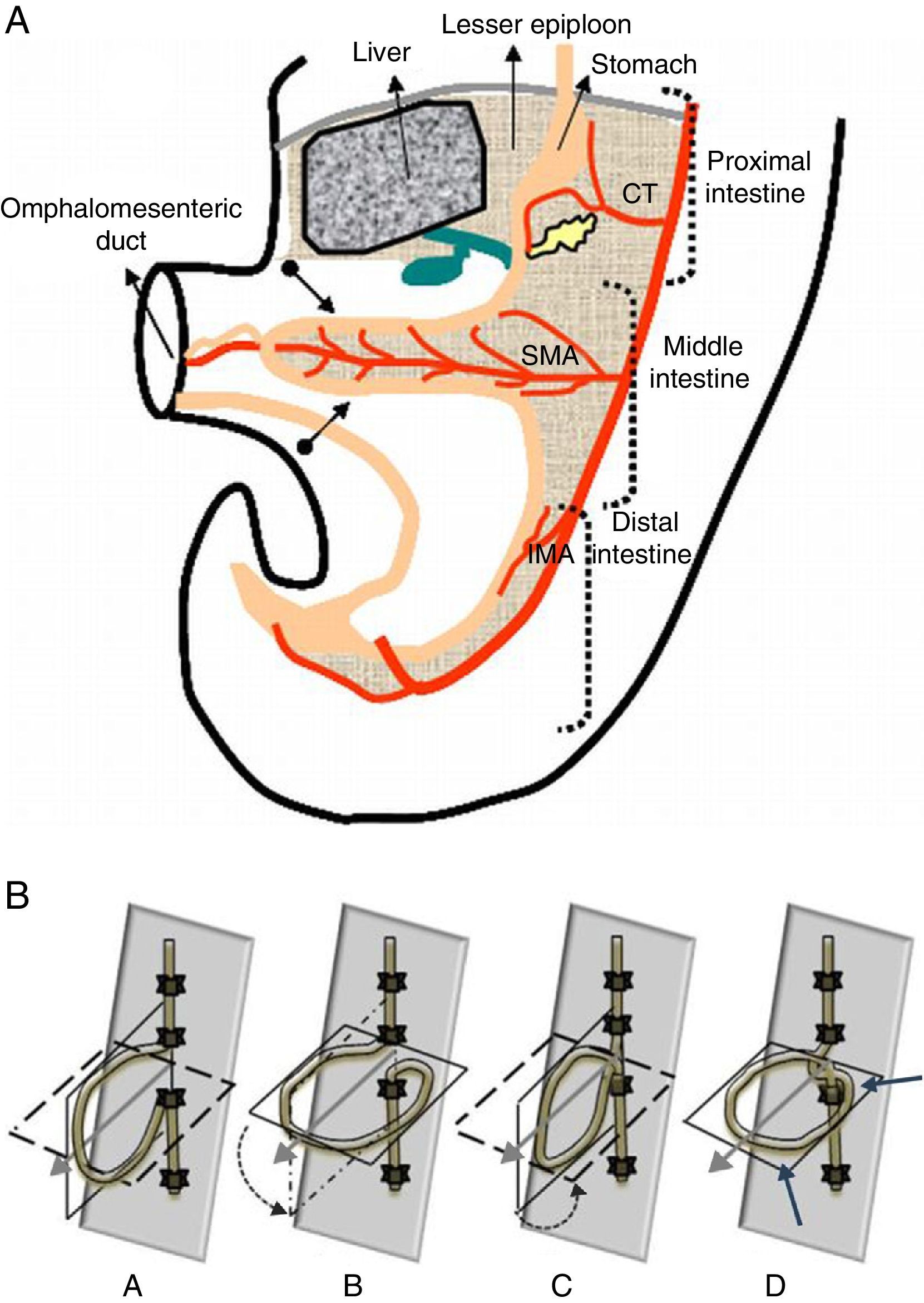 Intestinal malrotation – volvulus: Imaging findings | Radiología ...