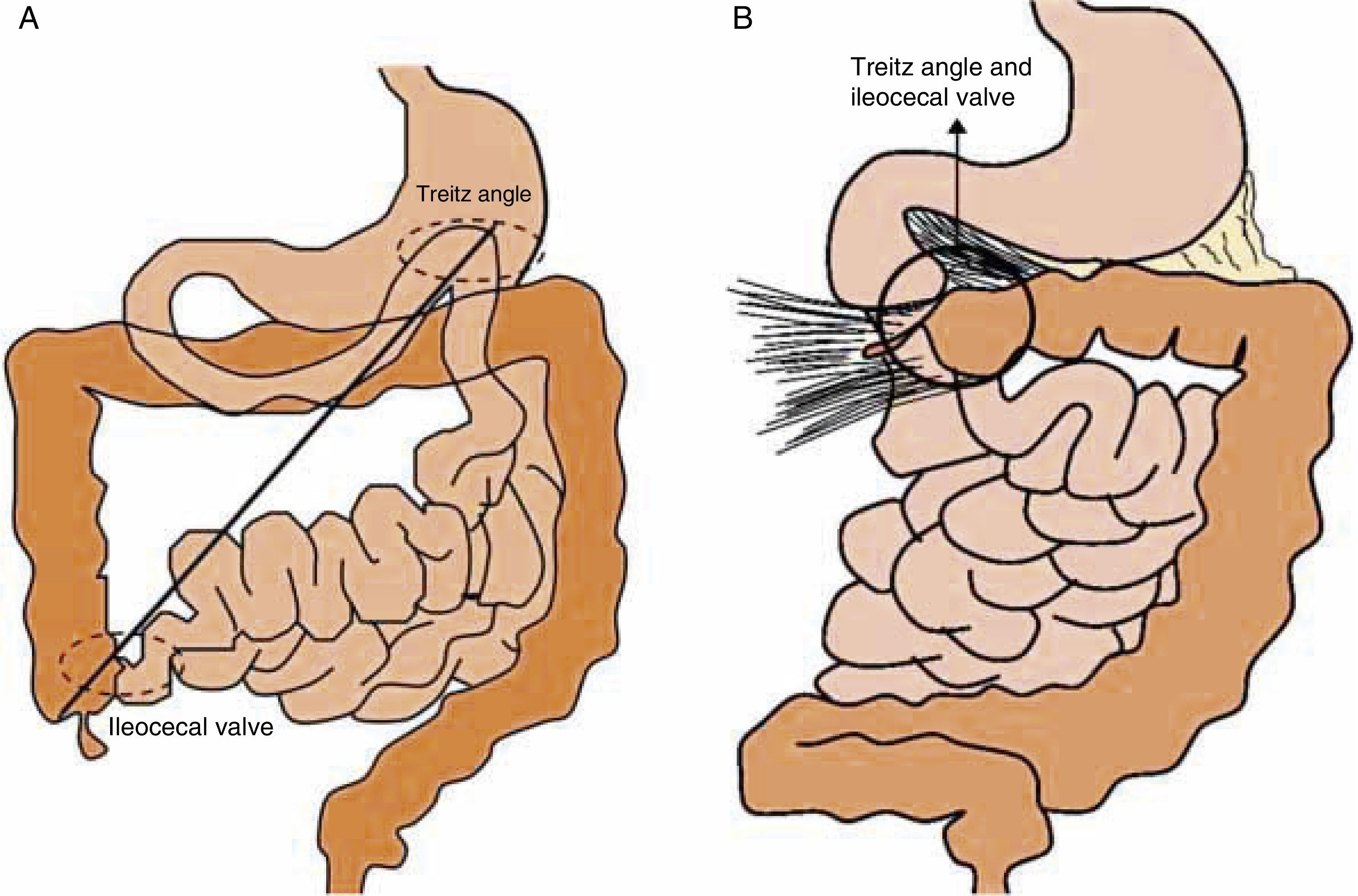 Normal Intestinal Fixation Intestinal malrotation – volvulus: Imaging findings | Radiología ...