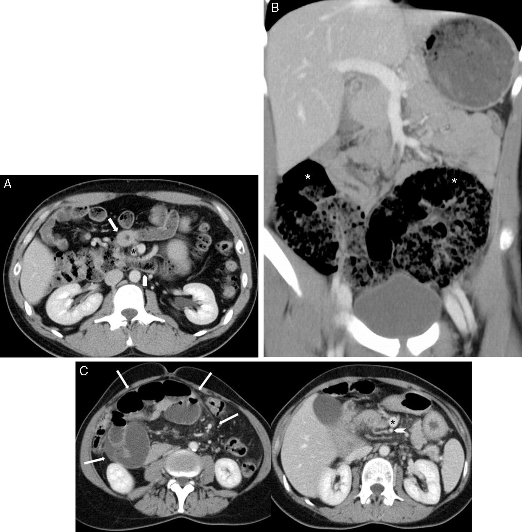 Intestinal malrotation – volvulus: Imaging findings | Radiología ...