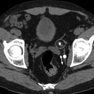 Computed axial tomography without contrast of a patient with left RC. Two pelvic calcifications are identified. One of them corresponds to an obstructive distal ureteral lithiasis showing a discontinued circle (halo sign) formed by the edematous ureteral wall around the lithiasis. Another larger and posterior calcification is a phlebolith with the comet tail sign, corresponding to a posterior trail made up of the vessel where the phlebolith is (parallel to the arrow).