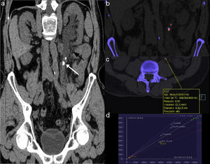 Computed tomography without contrast with double energy of a patient with symptoms of left RC. (a) Curve coronal reconstruction following the ureteral tract. The white arrow shows a proximal obstructive ureteral lithiasis. The perirenal and periureteral fat shows stringiness (black arrow). (b) Coronal image of application for renal lithiasis once the double energy information is processed showing a mixed composition of the obstructive lithiasis (red=uric acid, blue=not uric acid) and a pure uric acid composition of the proximal non-obstructive ureteral lithiasis. (c) and (d) Quantification of the pure uric acid lithiasis composition showing double energy relation <1 (0.91) and a location in the graph corresponding to uric acid lithiasis (KS2). The color in this figure is visible only in the electronic version of this article.