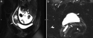 Magnetic resonance in a 20-week pregnant patient with right renal colic. (a) Coronal reconstruction showing ureter dilation (arrow) up to the pelvis. (b) T2-weighted axial sequence showing dilated distal ureter with juxtavesical intraureteral signal void image corresponding to lithiasis (arrow).