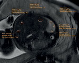T2-weighted axial image (HASTE). ROI for pulmonary (ROIs in the right hyperintense area) and hepatic measurements (ROIs in the left hypointense area).