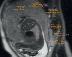 T2-weighted sagittal image (HASTE). ROI for pulmonary and hepatic fetal measurements.