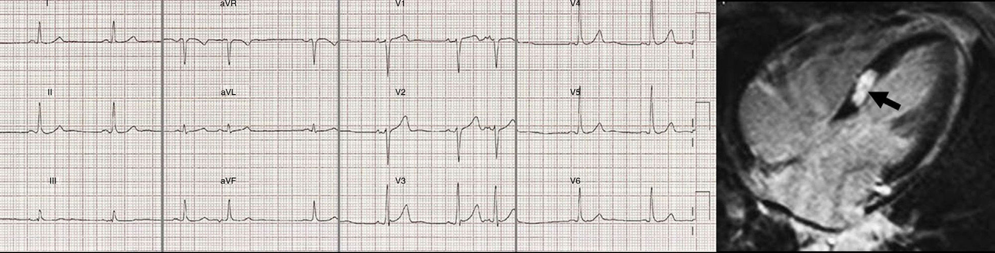 ISCHEMIC HEART DISEASE CARDIAC MRI visual data 6