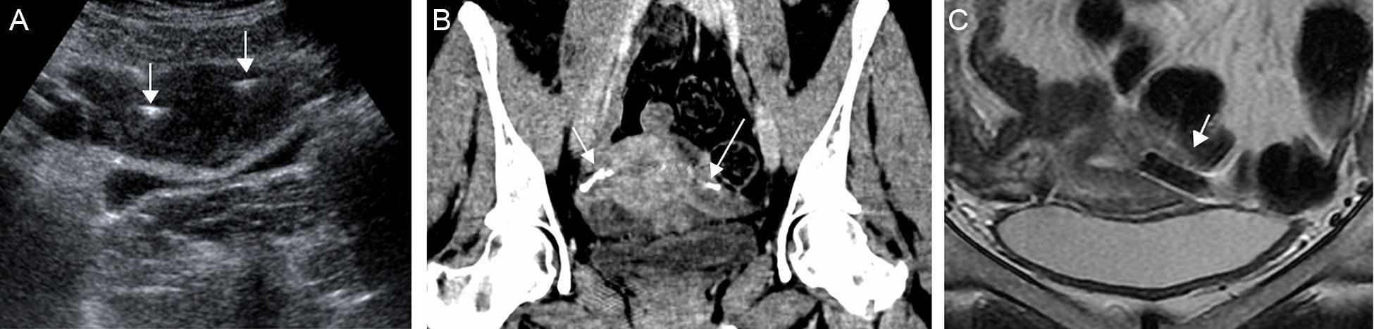 Radiological assessment of placement of the hysteroscopically inserted ...