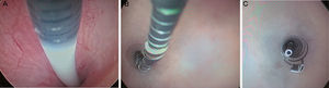 Essure insertion. (A) The catheter is introduced in the tube. (B) The device starts releasing the catheter while moving the wheel. (C) Once the Essure has been released and self-expanded a few coils from the exterior component and the end of the interior component in the uterine cavity can be seen.
