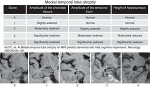 Scale of degree of atrophy of the medial temporal lobe (Scheltens et al.). The visual assessment of the temporal lobe atrophy was performed in 5 coronal cuts obtained parallel to the floor of the IV ventricle through T1-weighted inversion-recovery sequences. The cuts obtained in our study were analyzed with the Scheltens’ scale including scores from 0 to 4.