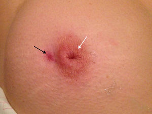 External paraareolar fistula located at the right breast of a 30-year-old patient (black arrow). The nipple is inverted (arrow head).