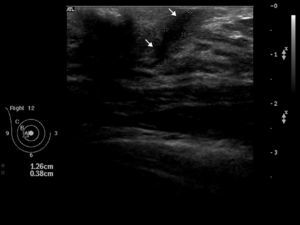 Ultrasound aspect of an external paraareolar fistula located at the right breast. Fistulous anechoic trajectory 1.26cm long by 0.28cm thick (white arrows).