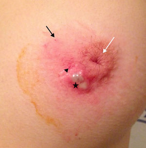 Aspect of left breast immediately after alcohol sclerosis in a 32-year-old patient showing an inner paraareolar fistula with 3 years of evolution. A retrograde puncture was performed (black arrow) in which the injected solution filled the fistula lumen, suppurated outwards (arrow head) and accumulated in a superficial collection (star). The nipple is inverted (white arrow).