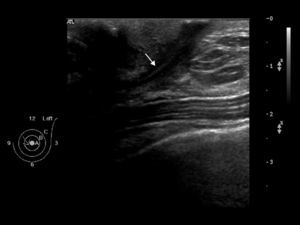 Ultrasound aspect of an inner paraareolar fistula located at the left breast closed after alcohol sclerosis. Inside the fistula lumen we can see an echogenic linear trajectory corresponding to the granulation tissue (white arrow).