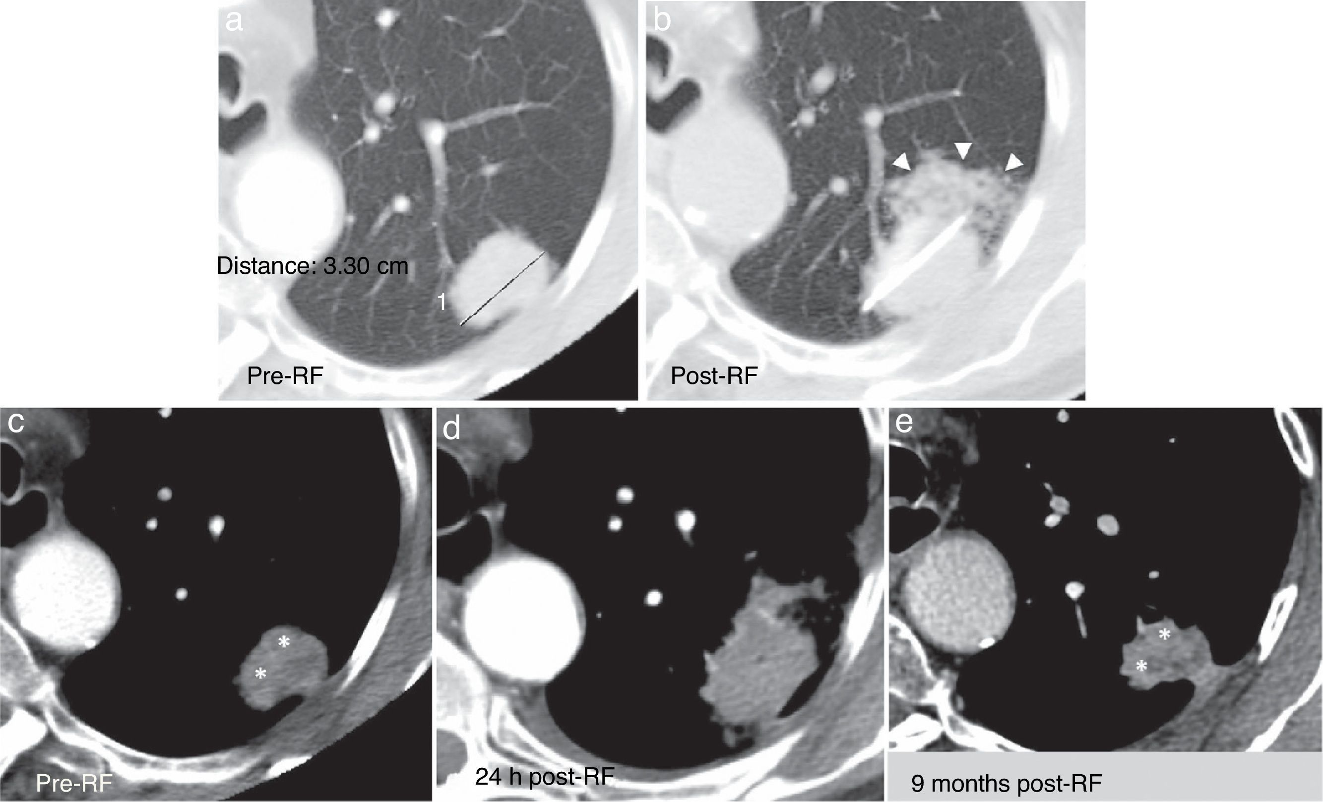 Pulmonary radiofrequency ablation (Part 1): Current state | Radiología ...
